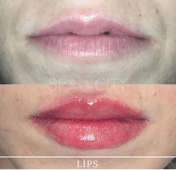 Lip Injection Results and What to Expect After Your Filler Treatment