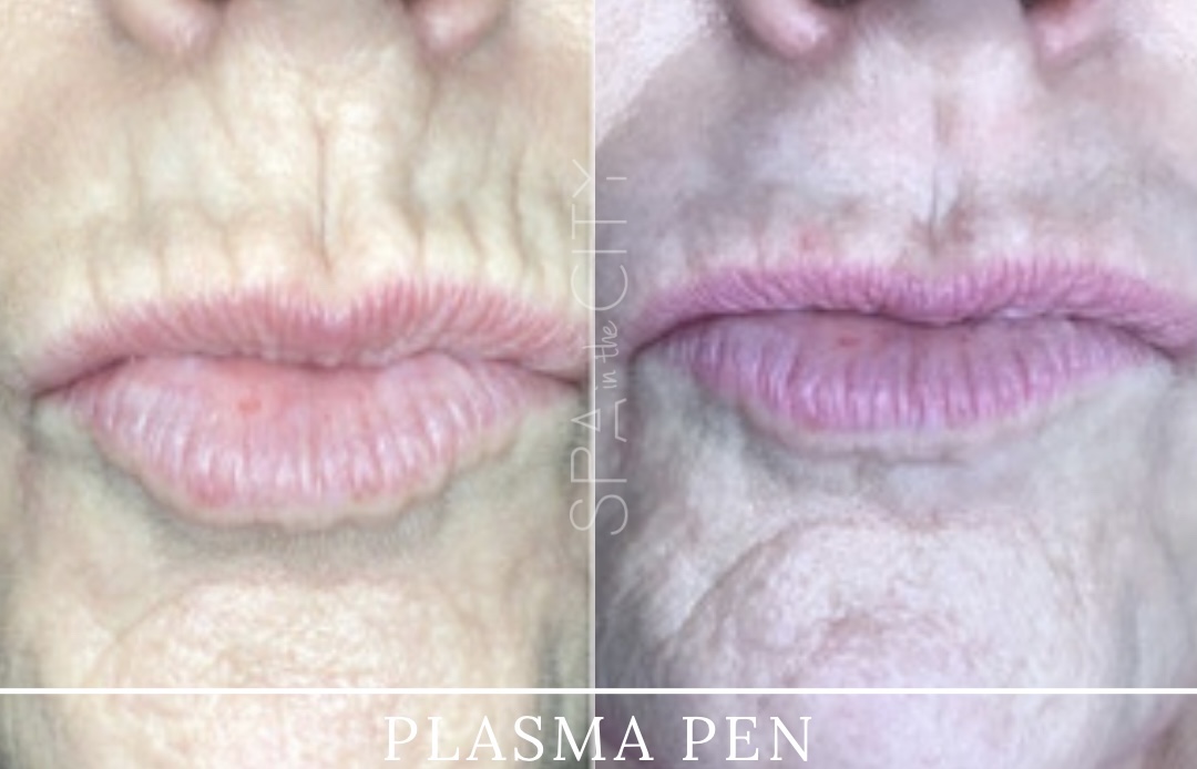 does plasma pen skin tightening really work?