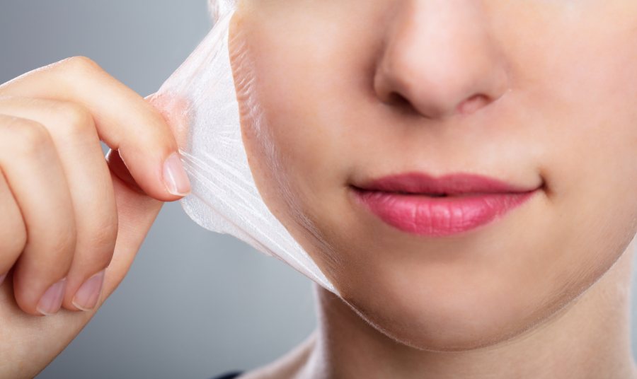 Chemical peels can be an excellent solution for individuals with oily, acne-prone skin or those dealing with post-acne marks and surface-level scarring.
