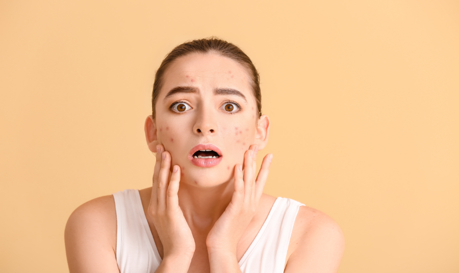 chemical peels have gained popularity as a promising method for managing acne and its lingering effects. 